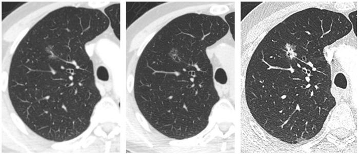看图说肺肺部磨玻璃结节恶性的随访