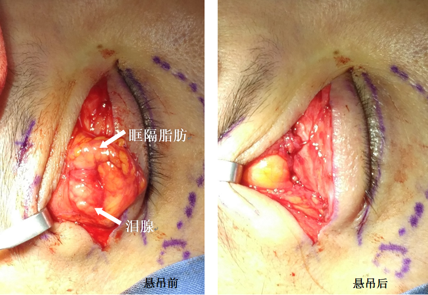 泪腺脱垂手术过程图片图片