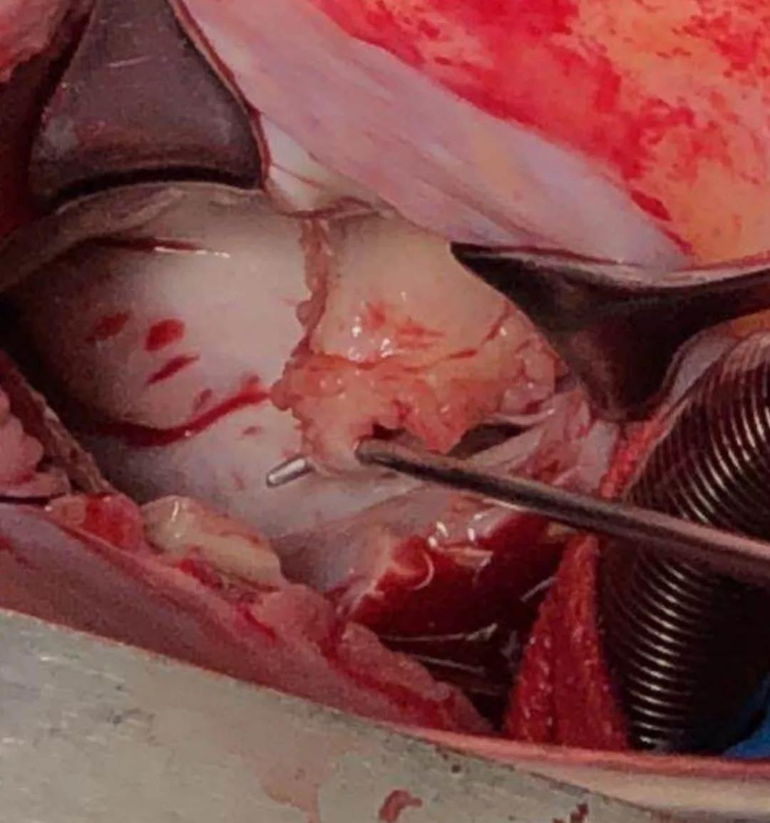 心脏瓣膜病患者必看!