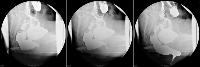 更小;耻骨直肠肌长度无明显增加,在肛管-直肠结合部多出现耻骨直肠肌