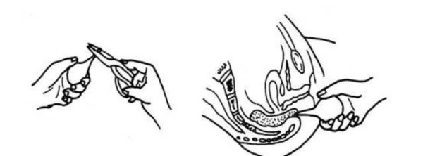 如何正确使用开塞露