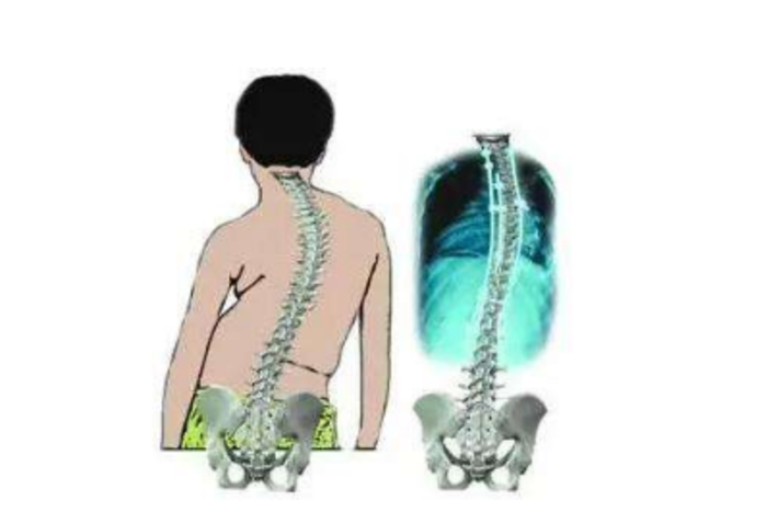 重度脊柱側彎如何治療這種方法最有效