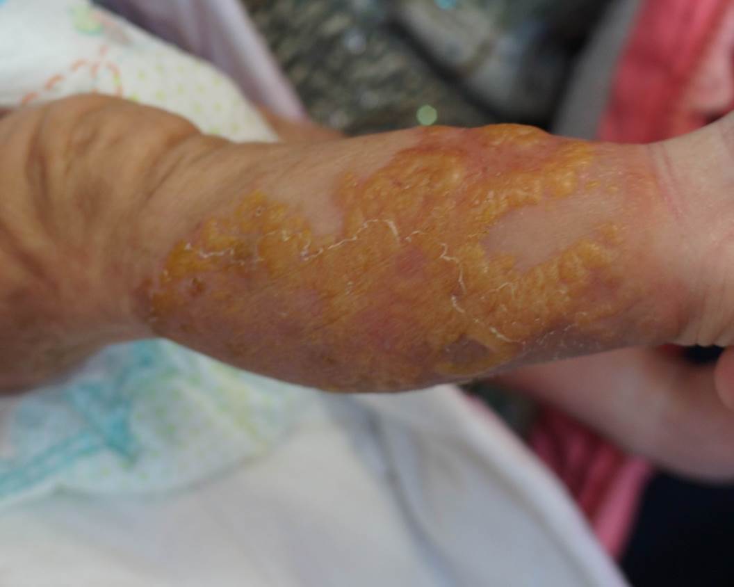 色素失禁症的临床表现和常见问题