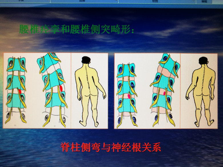 (1)腰椎侧凸是一种为减轻疼痛的姿势性代偿畸形.