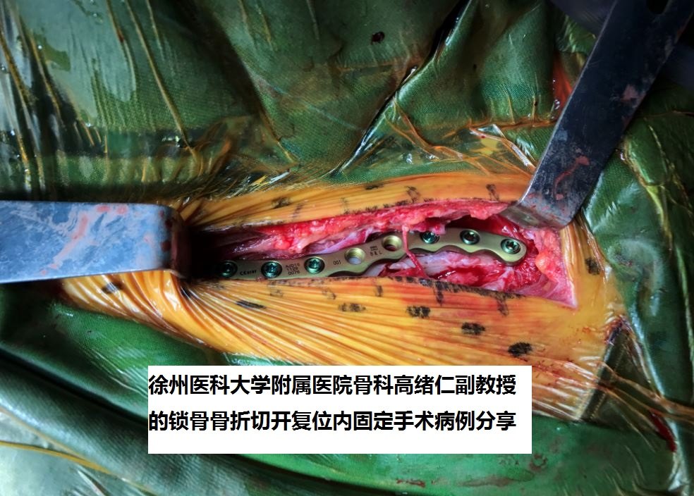 徐州二院骨科高绪仁如何切开复位钢板内固定治疗锁骨骨折