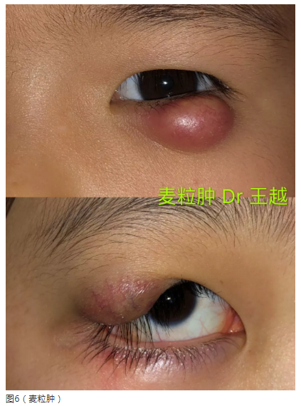 霰粒肿如何治疗