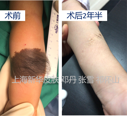 病例系列06几例手臂黑毛痣的治疗