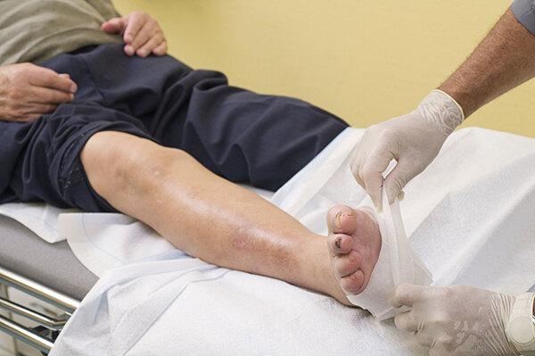 糖尿病足的症状及表现，日常护理怎么做_健康号-微医