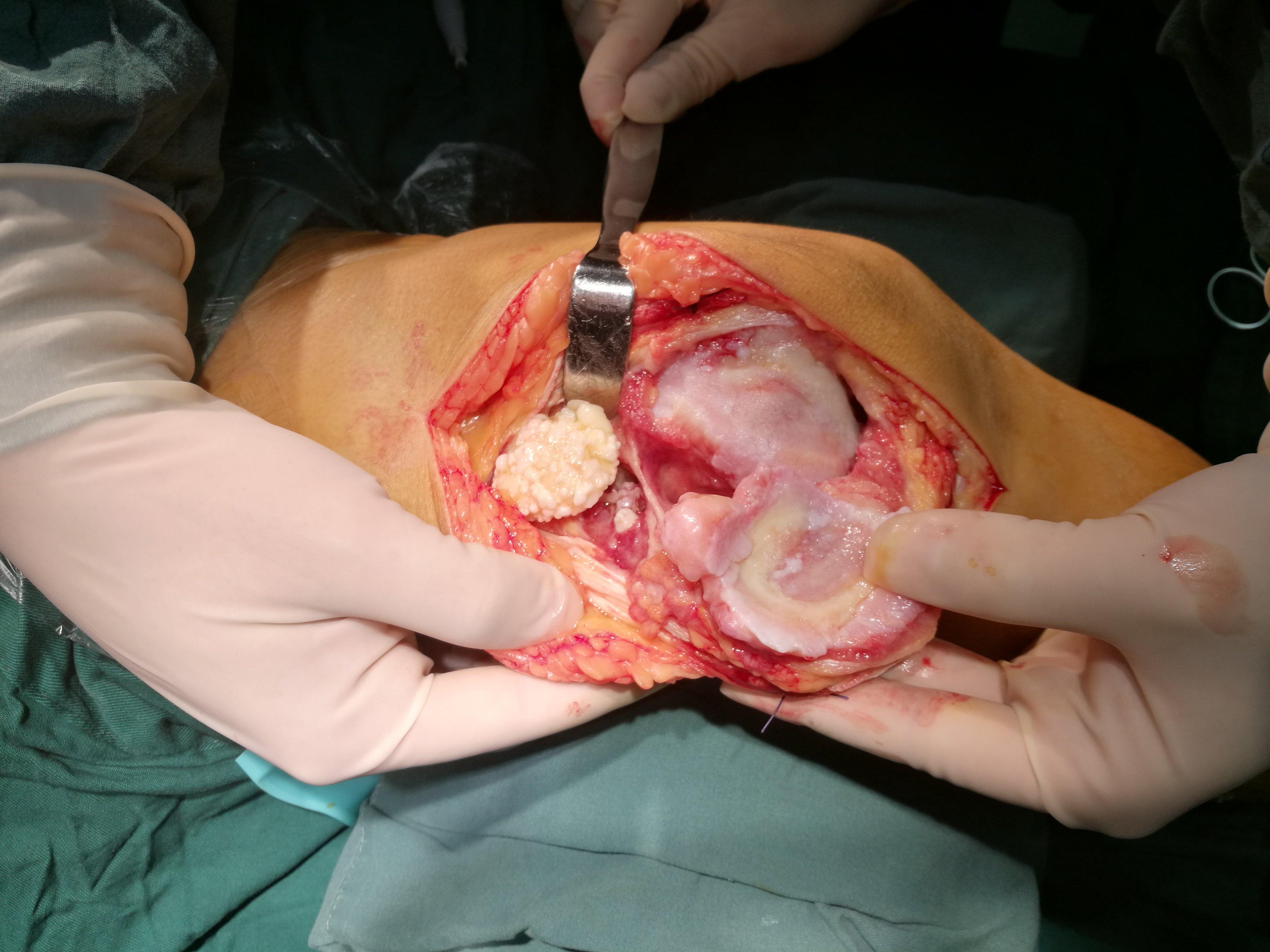 52岁女性外翻膝伴髌股关节炎dfo去旋转截骨