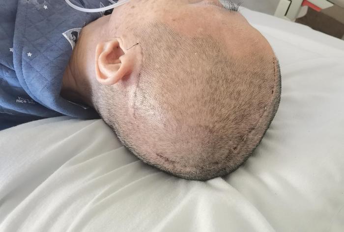 颅骨修补术中头皮切口缝合技术