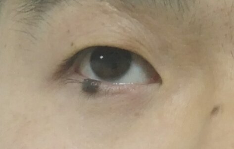 眼睑色素痣术前术后对比图_王俊芳医生文章_上海交通大学医学院附属第