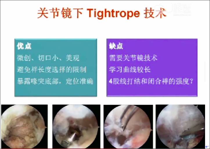 78亮点四:关节镜下tightrope技术的优点和缺点.