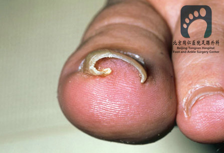 嵌甲的处理技巧与手术治疗