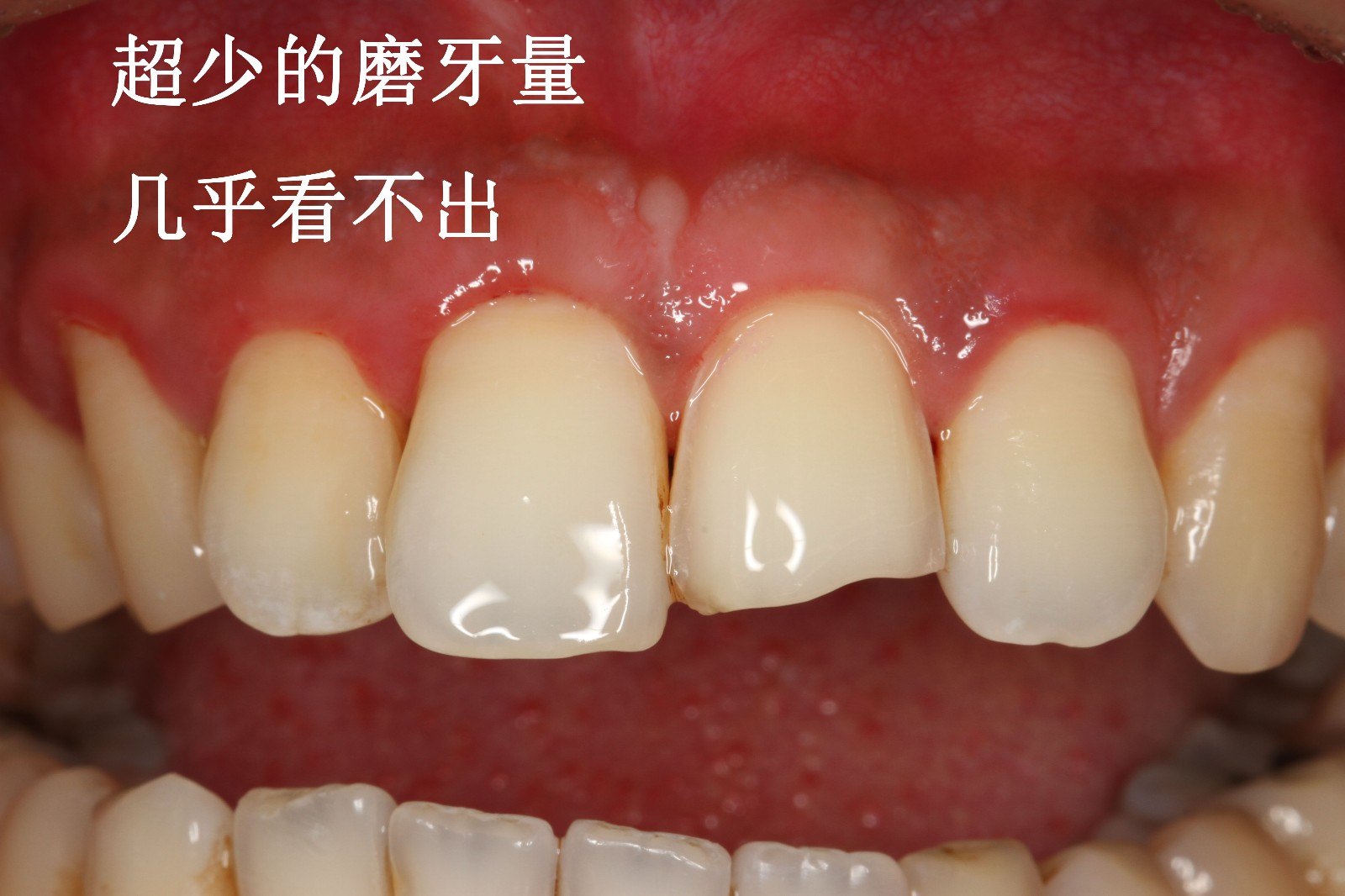 超薄贴面修复前牙缺损