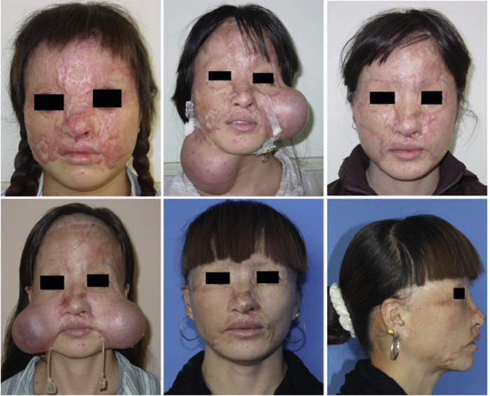 在颈部埋置扩张器修复面部瘢痕的方法一