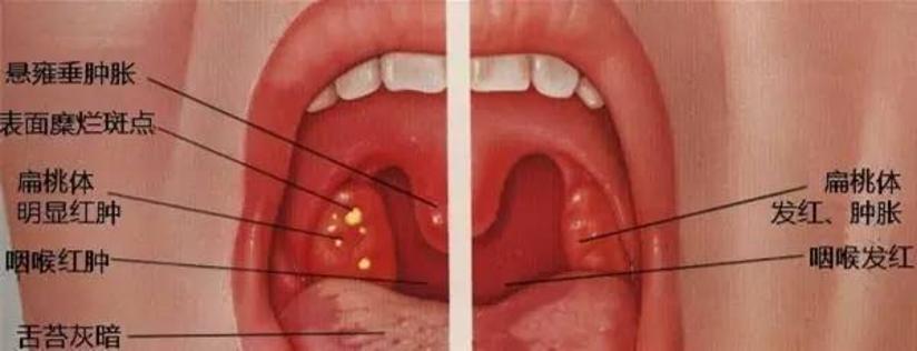 扁桃体化脓怎么回事 健康号 微医