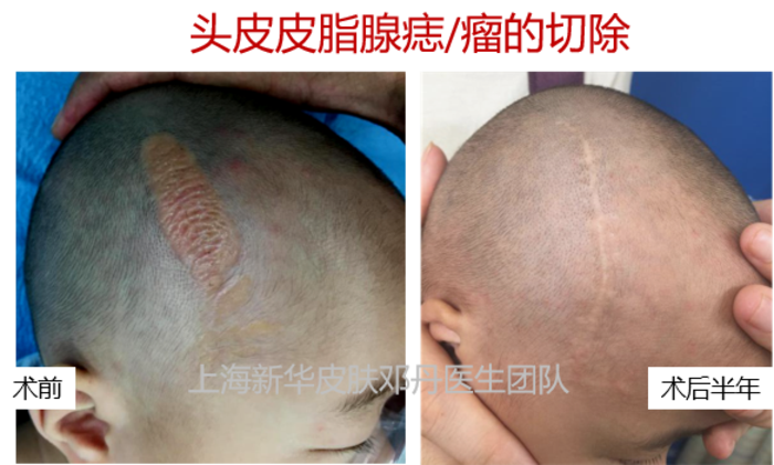 病例系列12皮脂腺痣头皮治疗热门问答