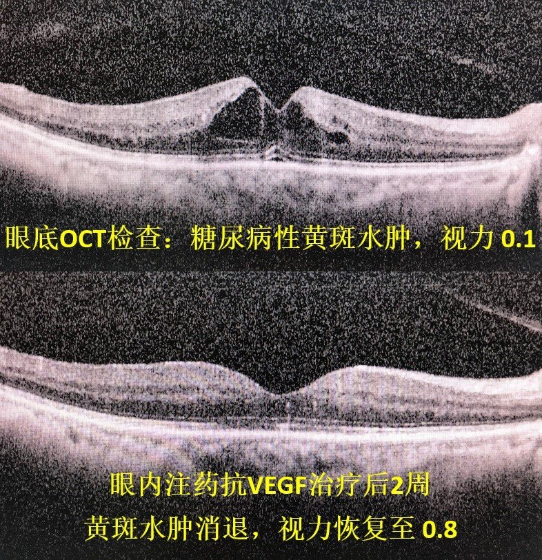 赵立全博士坐诊,针对糖尿病视网膜病变,黄斑水肿,高血压眼底出血,玻璃