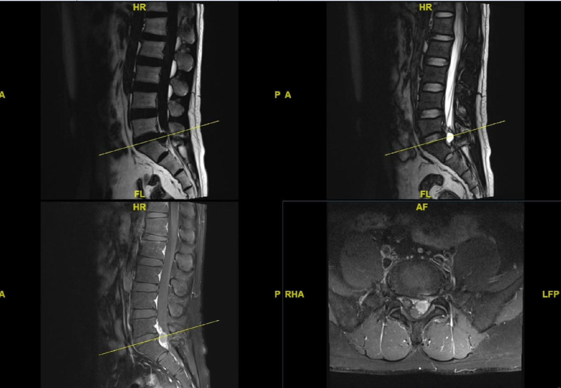 术中发现囊肿为神经袖套囊肿,与神经根关系非常密切,囊肿内为咖啡色