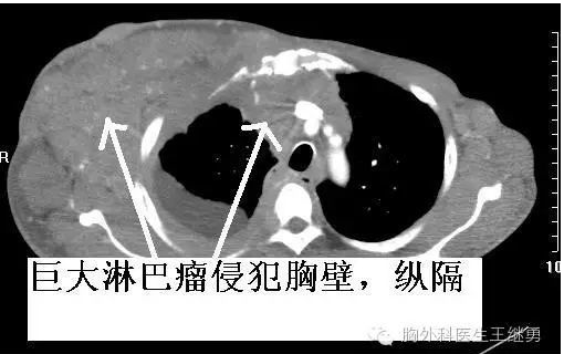纵隔肿瘤怎么治