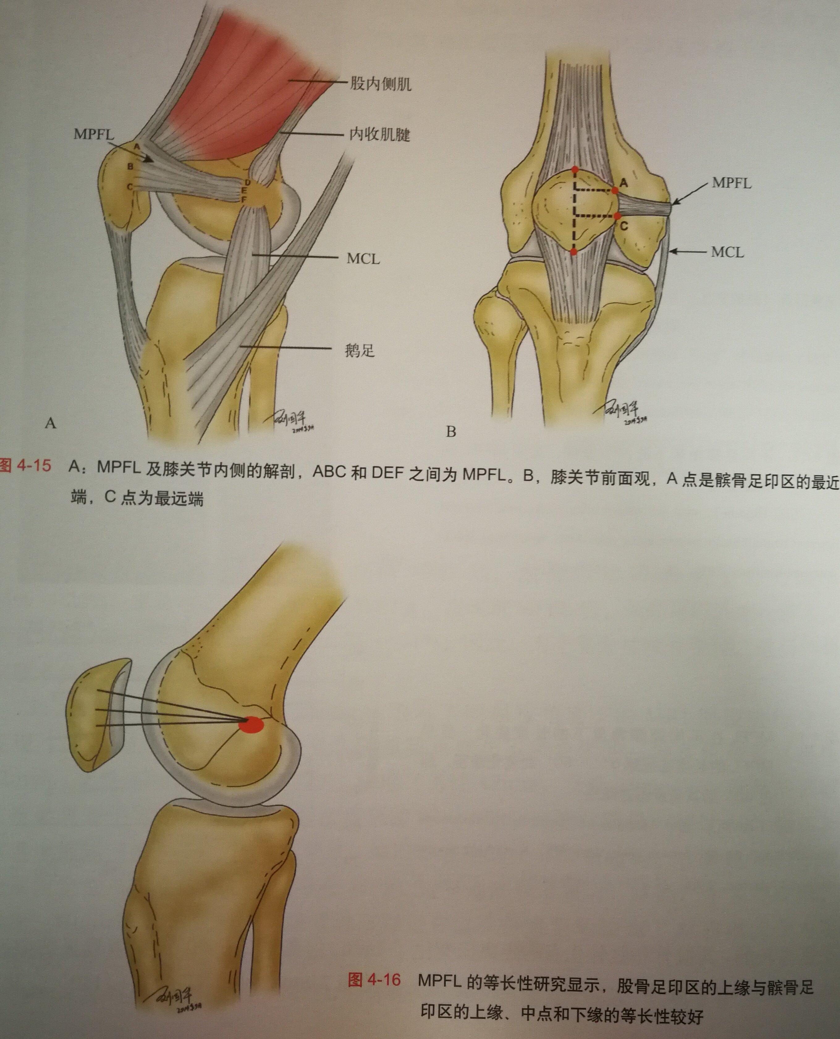 16岁复发性髌骨脱位股骨滑车发育不良mpfl重建