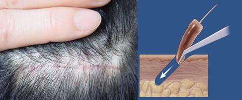 移植单位毛发移植术是将自体健康的毛囊和发干一起移植到毛发缺失部位
