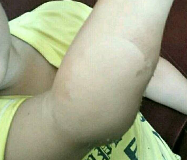 小儿关节皮下囊肿身体何种异常信号