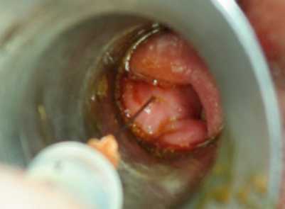 痔疮出血怎么治