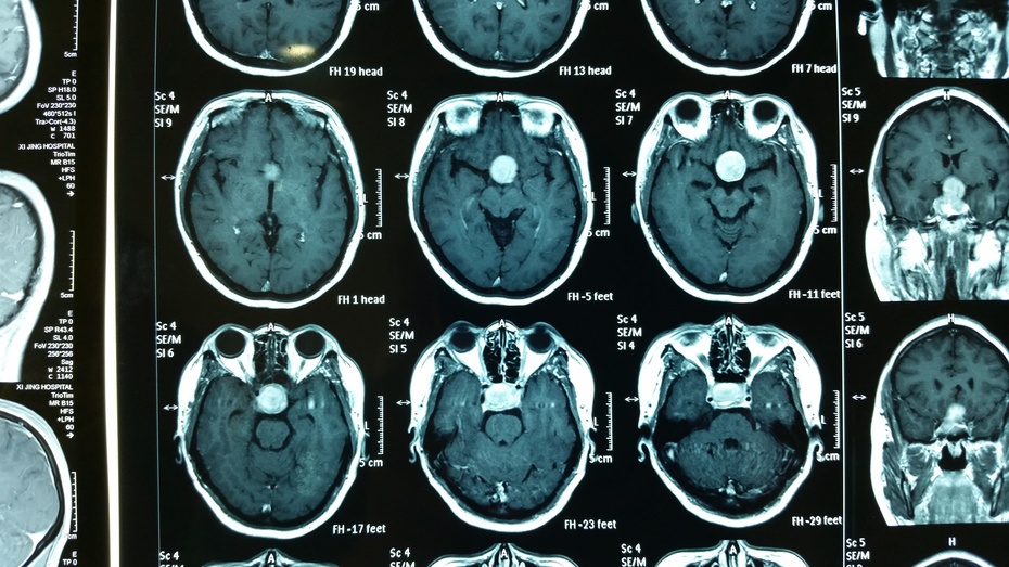 垂体微腺瘤致高泌乳素血症患者,术后用溴隐亭治疗而受孕
