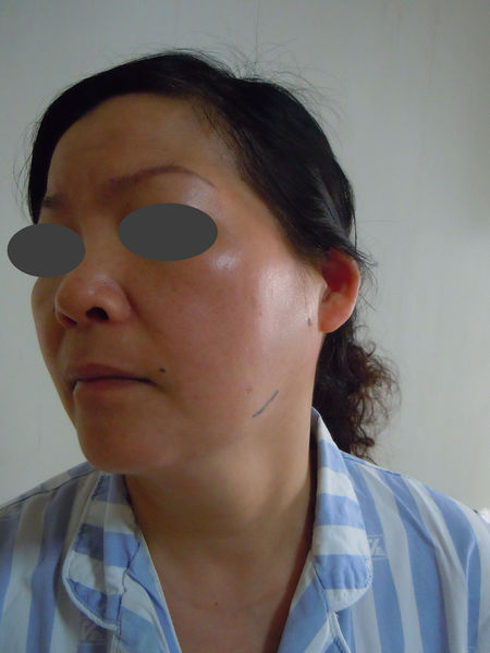 涎腺镜无创治疗慢性阻塞性腮腺炎2(有图片)