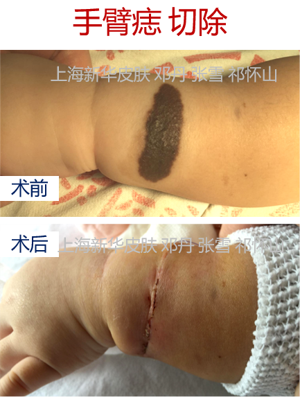 病例系列06几例手臂黑毛痣的治疗
