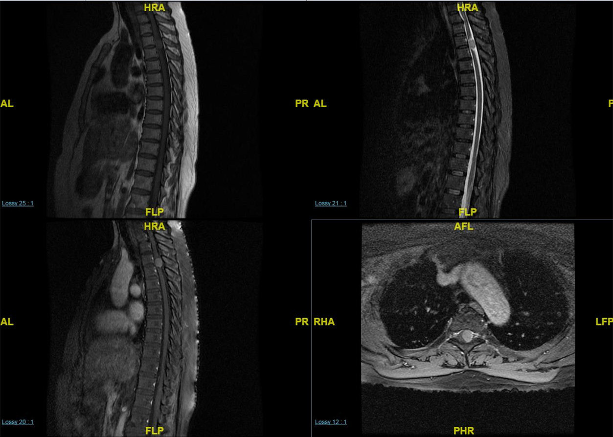 硬脊膜瘤图片