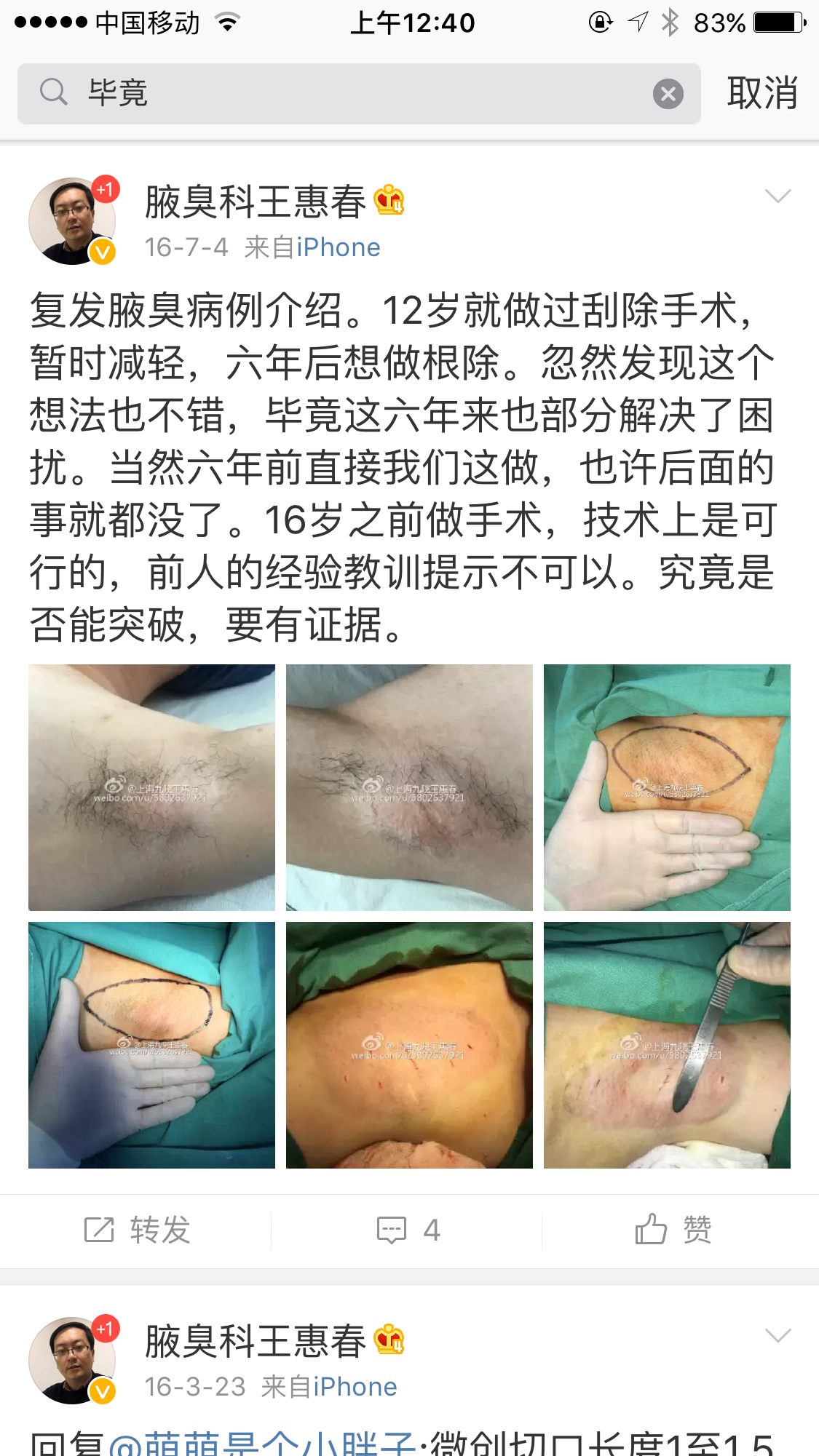 12歲可以做腋臭根除手術