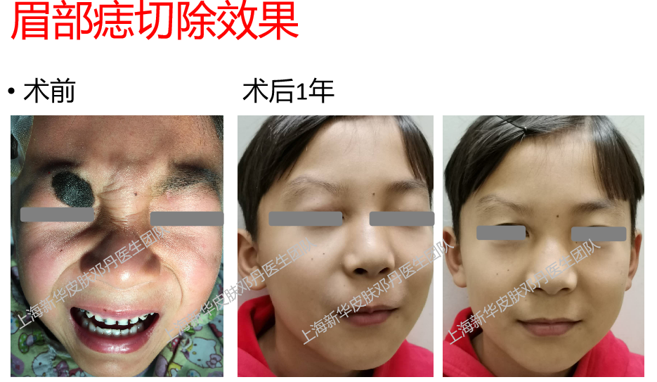 病例系列10环手指痣切除vs植皮