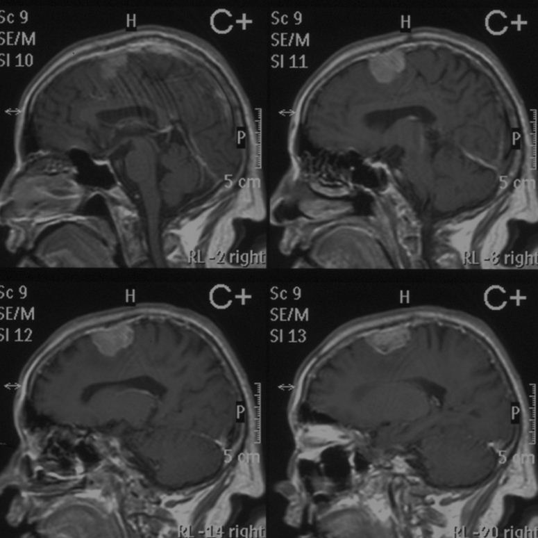 良性脑肿瘤不开刀可以吗脑膜瘤4年未治疗病例