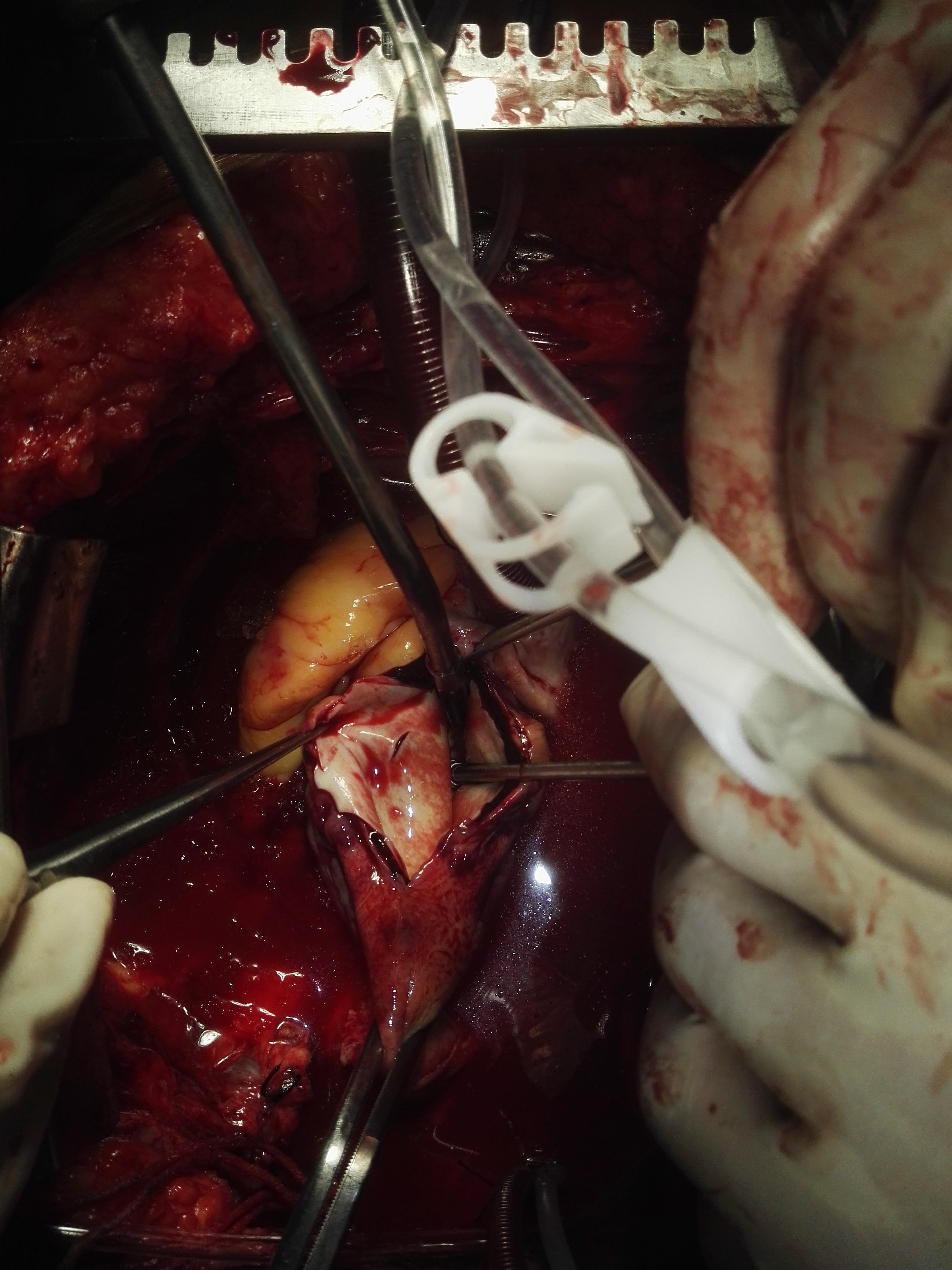 德州65岁240斤肥美女性遭遇a型主动脉夹层 - 微医(挂号网)