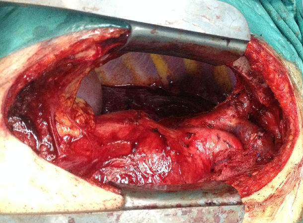 巨大侵袭性胸腺瘤的成功手术治疗