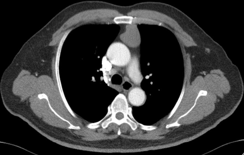 前纵隔结节前纵隔肿块胸腺囊肿thymiccyst和胸腺瘤如何区别需要手术吗