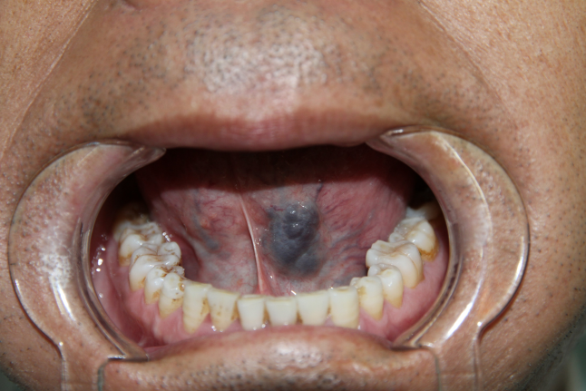 聚桂醇注射治疗口腔血管畸形