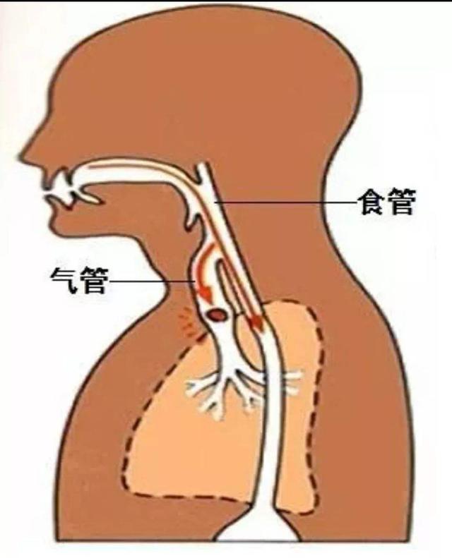 气管与胃管的结构图图片