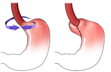 "胃底折叠术"知多少 - 微医(挂号网)