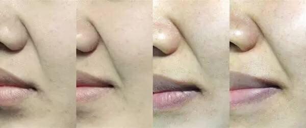 上海九院亚洲人鼻唇沟分型与治疗策略