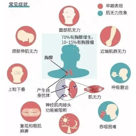 运动神经元病和重症肌无力有哪些区别