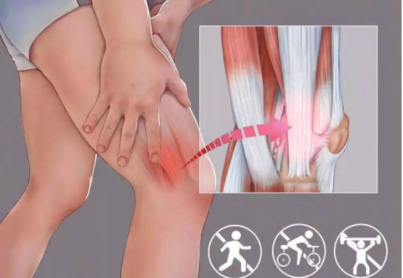 跑步膝之髂胫束疼痛综合征