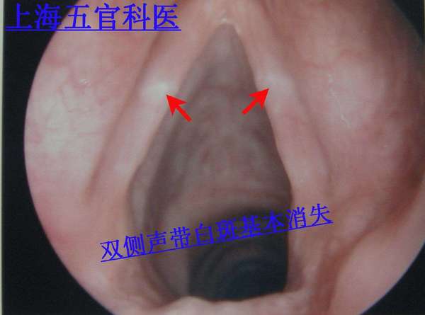 喉咙白斑是什么病图片