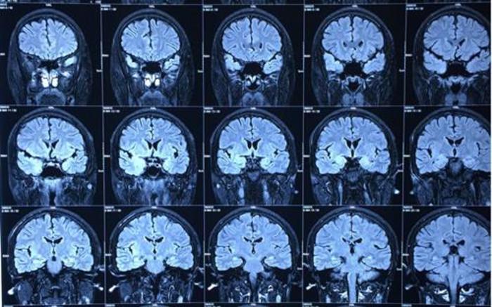 进行性的记忆力下降,痴呆的症状,建议行颞叶海马杏仁核切除手术治疗