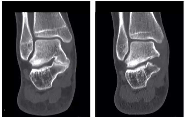 跟距骨桥的微创治疗(关节镜下切除术) - 微医(挂号网)