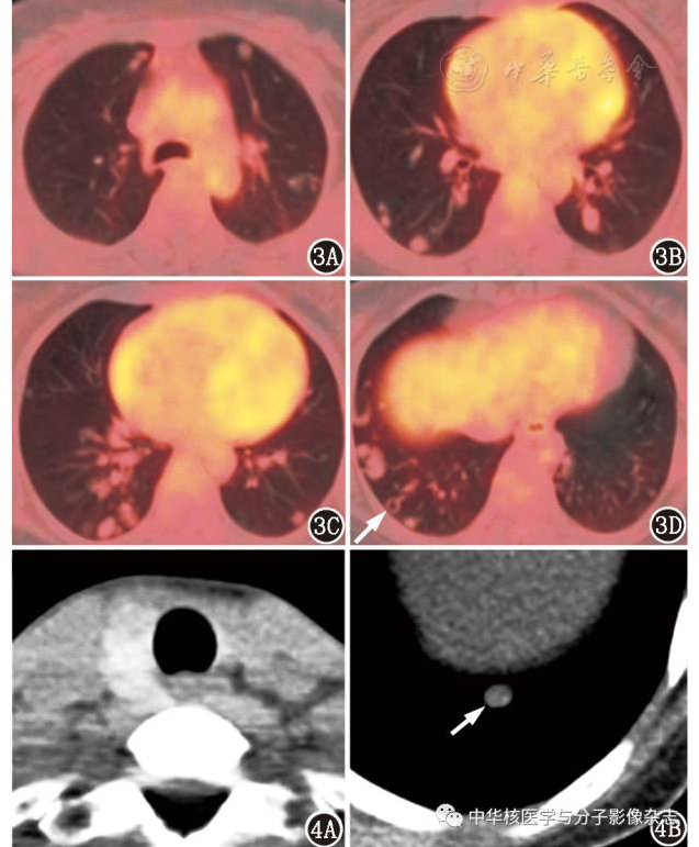 【病案分析】甲状腺癌肺转移:简单中的不