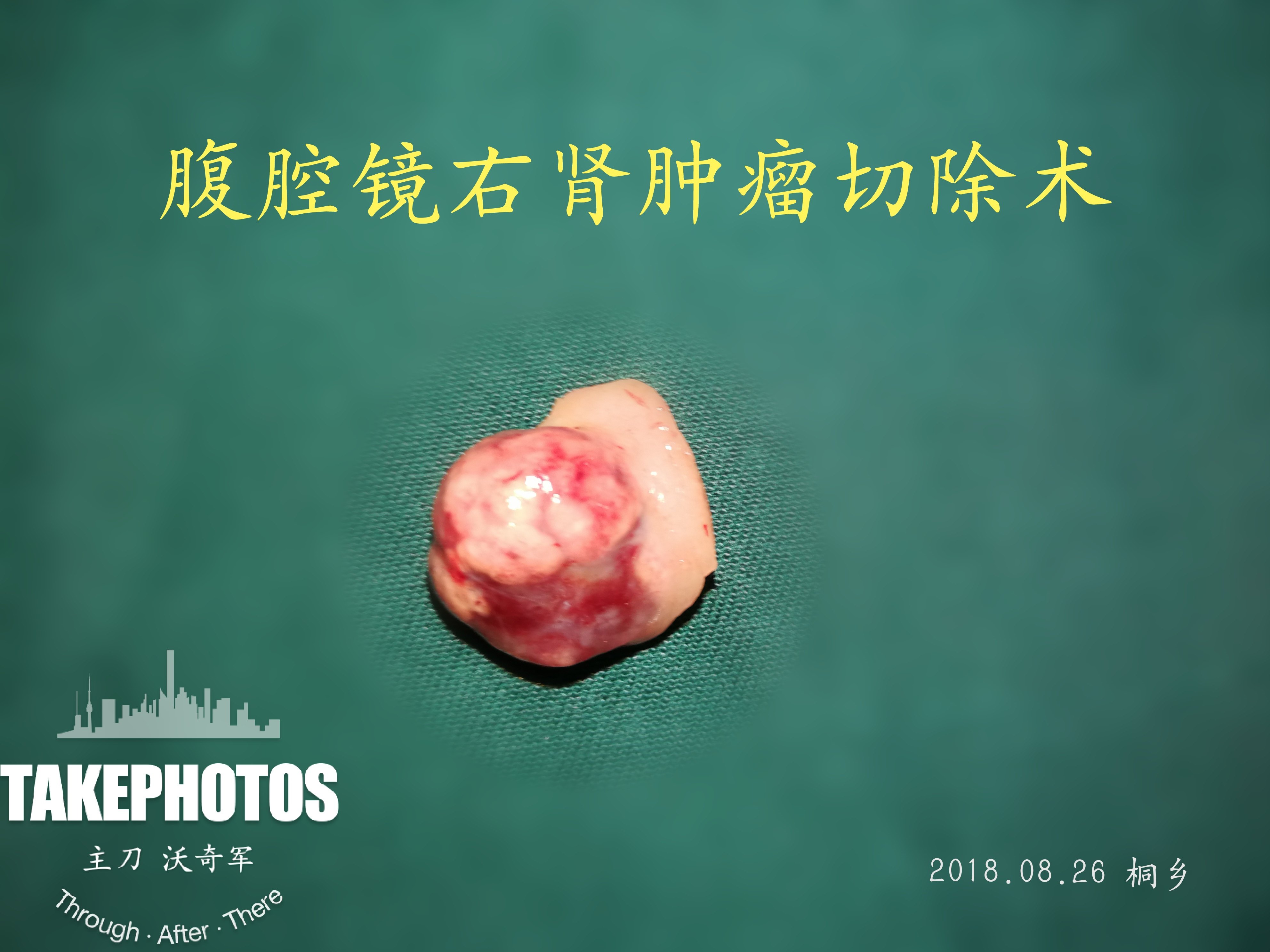 沃医生主刀手术8肾肿瘤切不切肾这个备胎你还要吗