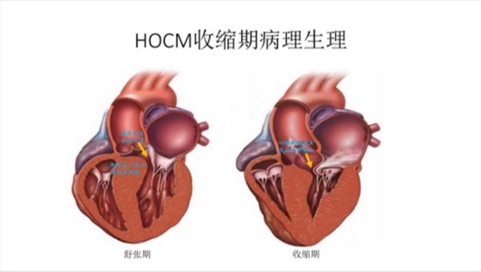 肥厚梗阻型心肌病的精准消融